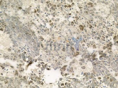 C9orf156 Antibody - DF2619 at 1/100 staining human melanoma by IHC-P.