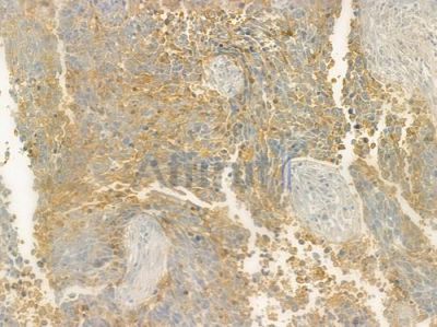 ATRN Antibody - DF2632 at 1/100 staining human large cell lung carcinoma by IHC-P.