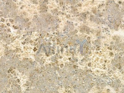 ATRN Antibody - DF2632 at 1/100 staining human melanoma by IHC-P.