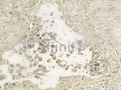 STK17A Antibody - DF2664 at 1/100 staining human prostate carcinoma by IHC-P.