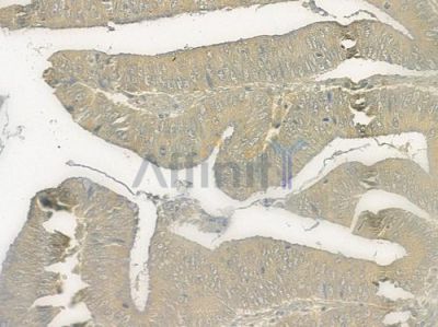 CEACAM3 Antibody - DF2694 at 1/100 staining human renal cell carcinoma by IHC-P.