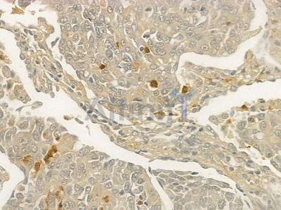 CCR1 Antibody - DF2710 at 1/100 staining human lung squamous cell carcinoma by IHC-P.