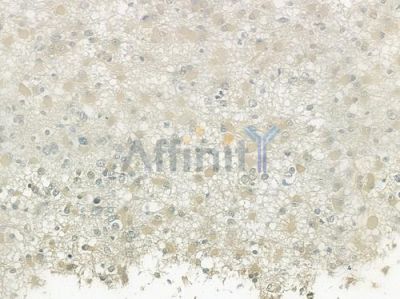 EDG8 Antibody - DF2714 at 1/100 staining human thyroid carcinoma by IHC-P.