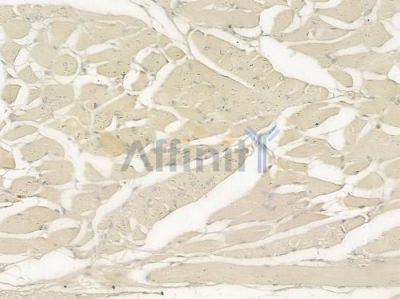 GPR56 Antibody - DF2753 at 1/100 staining human tongue carcinoma by IHC-P.