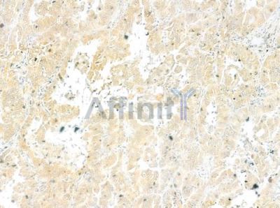 C5ARL Antibody - DF2762 at 1/100 staining human hepatocellular carcinoma by IHC-P.