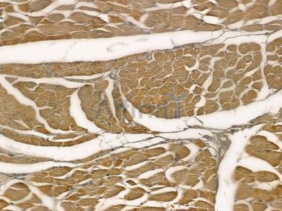 OR1G1 Antibody - DF2837 at 1/100 staining human tongue carcinoma by IHC-P.