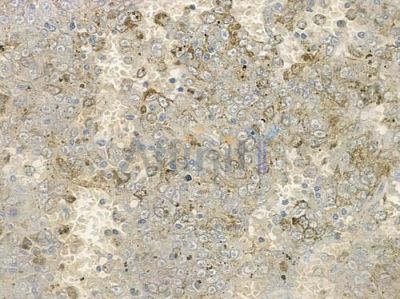 OR1L3 Antibody - DF2843 at 1/100 staining human melanoma by IHC-P.
