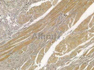 OR2H1 Antibody - DF2847 at 1/100 staining human tongue carcinoma by IHC-P.