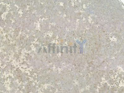OR2M4 Antibody - DF2850 at 1/100 staining human melanoma by IHC-P.