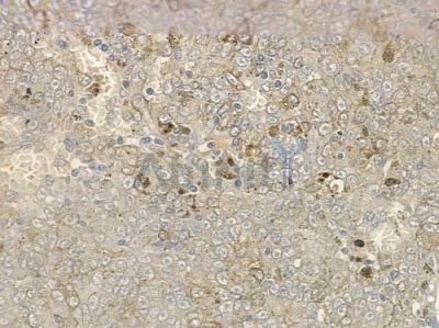 OR2T27 Antibody - DF2852 at 1/100 staining human melanoma by IHC-P.