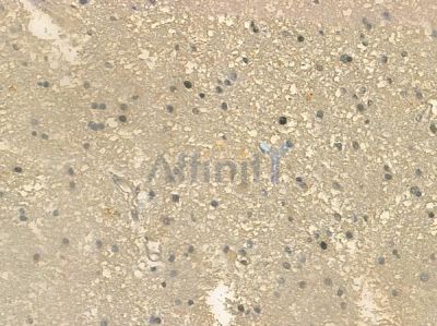 OR2W1 Antibody - DF2856 at 1/100 staining human glioblastoma by IHC-P.