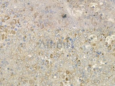 alpha Tubulin 4A Antibody - DF2901 at 1/100 staining human melanoma by IHC-P.