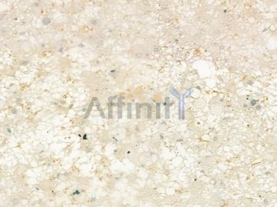 CaMKII Antibody - DF2907 at 1/100 staining human astrocytoma by IHC-P.