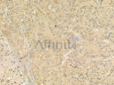 Cubilin Antibody - DF2914 at 1/100 staining human hepatocellular carcinoma by IHC-P.