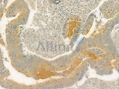 Cubilin Antibody - DF2914 at 1/100 staining human colon carcinoma by IHC-P.