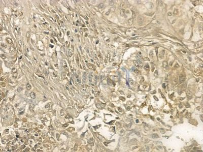 Phospho-Cdk1/2 (Thr14) Antibody - DF2944 at 1/100 staining human lung squamous cell carcinoma by IHC-P.