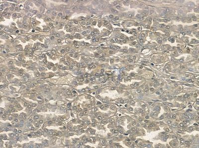 Phospho-Smad5 (Ser463/Ser465) Antibody - DF2950 at 1/100 staining human pancreatic cancer and para-carcinoma tissue by IHC-P.