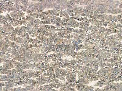 Phospho-Smad5 (Ser463/Ser465) Antibody - DF2950 at 1/100 staining human renal cell carcinoma by IHC-P.