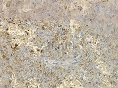 Rho A + B + C Antibody - DF2959 at 1/100 staining human melanoma by IHC-P.