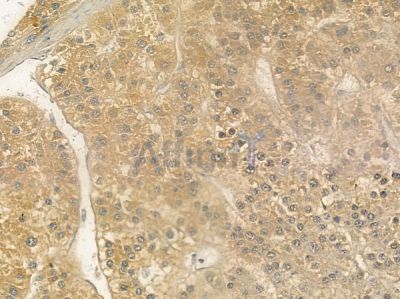 PDLIM1 Antibody - DF3003 at 1/100 staining human hepatocellular carcinoma by IHC-P.