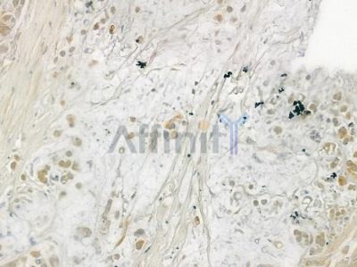 DLX3 Antibody - DF3029 at 1/100 staining human gastric carcinoma by IHC-P.