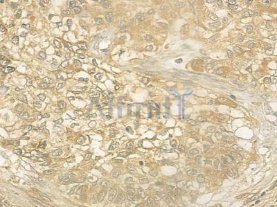 LRAT Antibody - DF3055 at 1/100 staining human lung squamous cell carcinoma by IHC-P.