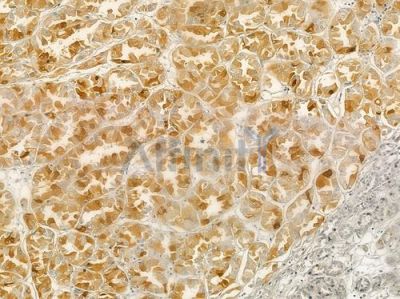 HMG17 Antibody - DF3070 at 1/100 staining human renal cell carcinoma by IHC-P.
