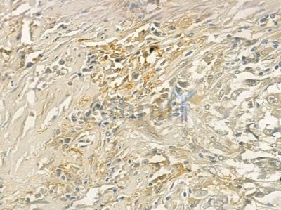 HEXB Antibody - DF3074 at 1/100 staining human lung squamous cell carcinoma by IHC-P.