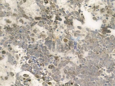 CEBPG Antibody - DF3210 at 1/100 staining human melanoma by IHC-P.