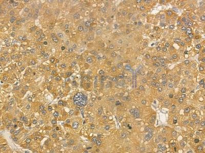 RBP5 Antibody - DF3229 at 1/100 staining human hepatocellular carcinoma by IHC-P.