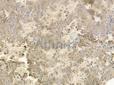 TRIM59 Antibody - DF3343 at 1/100 staining human melanoma by IHC-P.