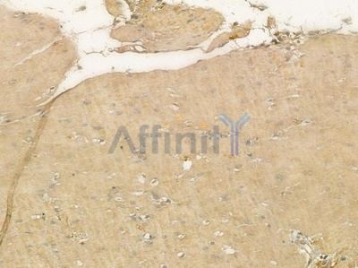 LMTK2 Antibody - DF3344 at 1/100 staining human glioblastoma by IHC-P.