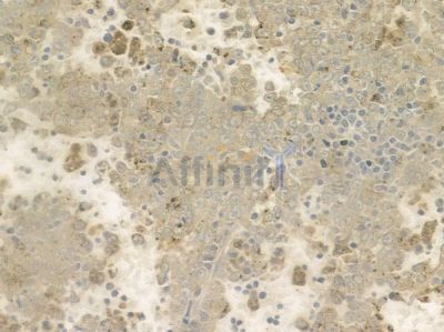 ES8L1 Antibody - DF3367 at 1/100 staining human melanoma by IHC-P.