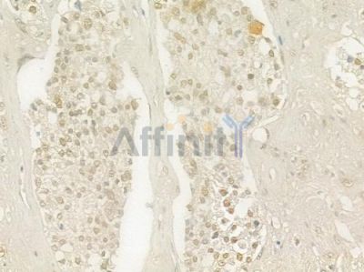 EZH1 Antibody - DF3381 at 1/100 staining human prostate carcinoma by IHC-P.