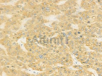 JAKMIP2 Antibody - DF3393 at 1/100 staining human hepatocellular carcinoma by IHC-P.
