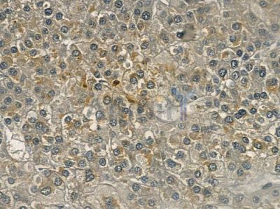 NT5C3 Antibody - DF3430 at 1/100 staining human hepatocellular carcinoma by IHC-P.
