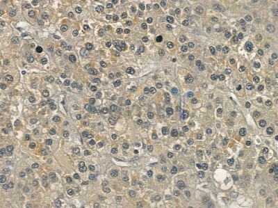 SEMA4A Antibody - DF3434 at 1/100 staining human hepatocellular carcinoma by IHC-P.