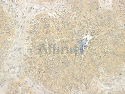 5HT2C Receptor Antibody - DF3501 at 1/100 staining human cervical carcinoma by IHC-P.