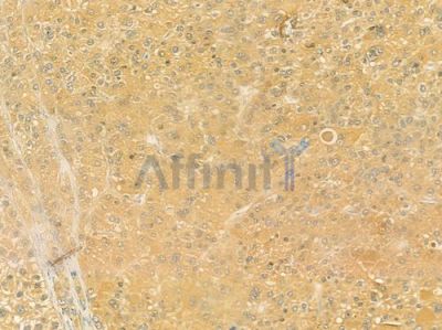 5HT2C Receptor Antibody - DF3501 at 1/100 staining human hepatocellular carcinoma by IHC-P.