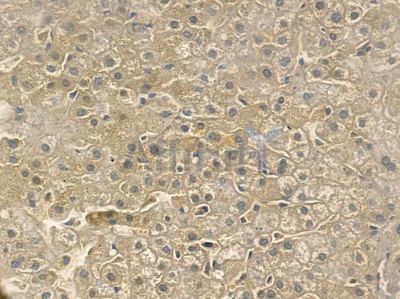ADCY5/6 Antibody - DF3508 at 1/100 staining human gastric carcinoma by IHC-P.