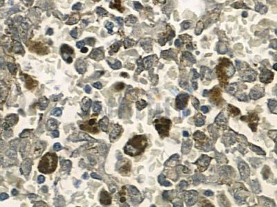 API-5 Antibody - DF3515 at 1/100 staining human melanoma by IHC-P.