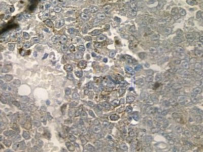 CDH22 Antibody - DF3529 at 1/100 staining human melanoma by IHC-P.