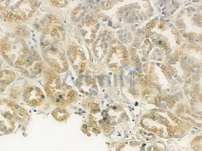 CDH9 Antibody - DF3534 at 1/100 staining human renal cell carcinoma by IHC-P.