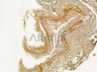 Collagen IV  alpha 2 Antibody - DF3550 at 1/100 staining human lung adenocarcinoma by IHC-P.