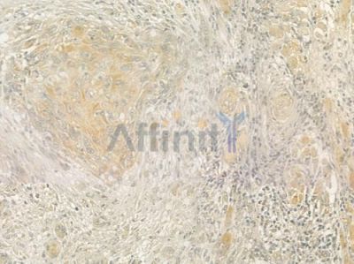 Collagen V  alpha 1 Antibody - DF3551 at 1/100 staining human tongue carcinoma by IHC-P.