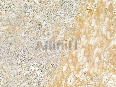 Collagen VI alpha 2 Antibody - DF3552 at 1/100 staining human Hodgkin lymphoma by IHC-P.