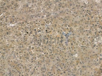 Cytochrome P450 2C8 Antibody - DF3575 at 1/100 staining human hepatocellular carcinoma by IHC-P.