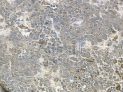 MRPS18C Antibody - DF3649 at 1/100 staining human melanoma by IHC-P.