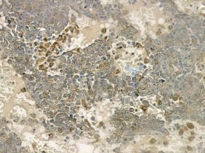 MRPS7 Antibody - DF3651 at 1/100 staining human melanoma by IHC-P.