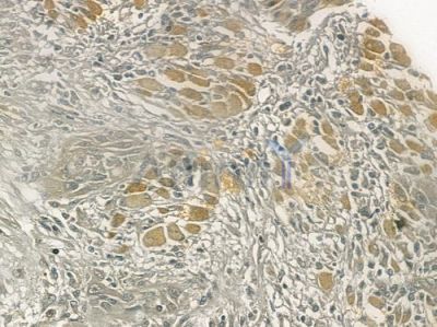 MRPL54 Antibody - DF3654 at 1/100 staining human tongue carcinoma by IHC-P.